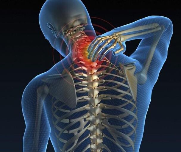 Cervical osteochondrosis