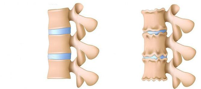 Lumbar osteochondrosis